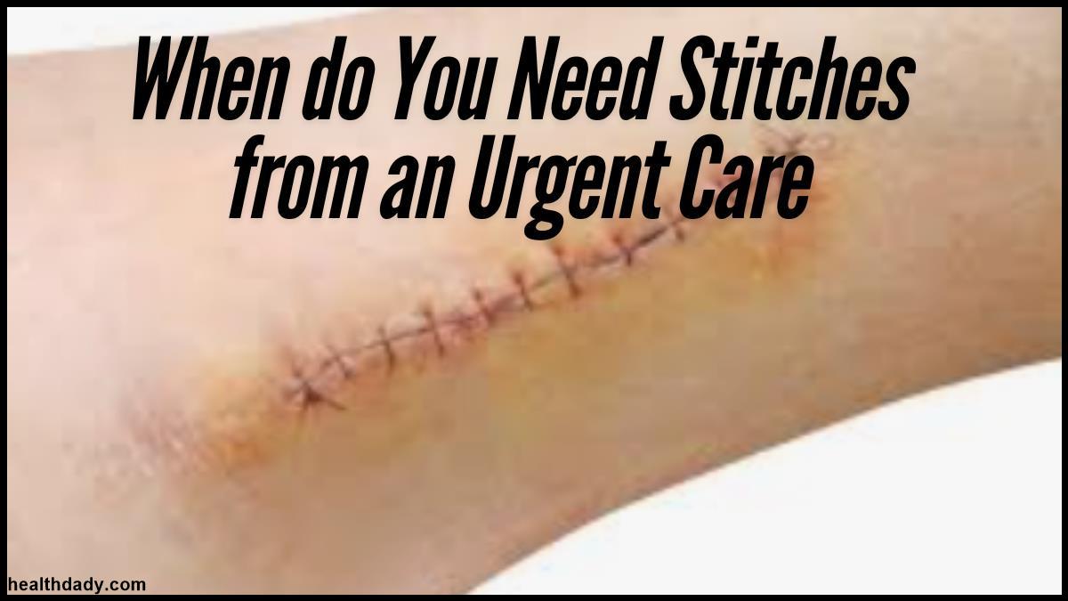 When do You Need Stitches from an Urgent Care.jpg